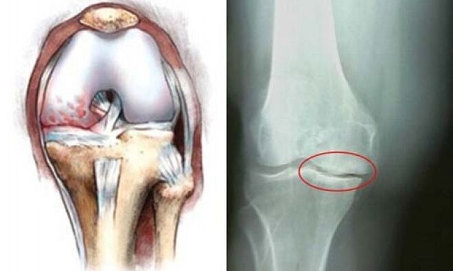 X-ray of knee osteoarthritis