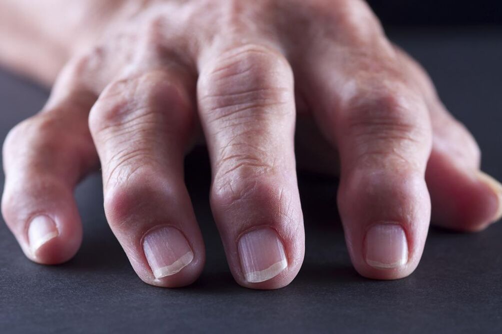 Bursitis is characterized by pain, inflammation and swelling of the finger joints