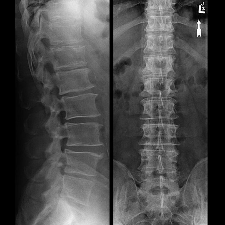 Snot spine with osteochondrose