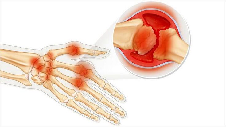 Damage to arm joints due to arthritis