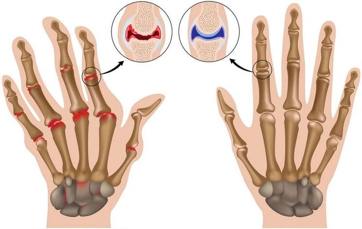 Healthy wrists and joints damaged by arthrosis