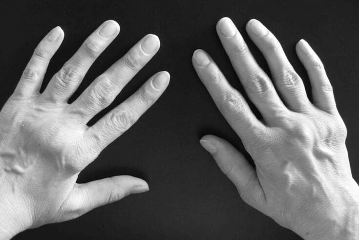 Symptoms of arthritis in arm joints