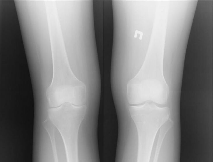 X-ray of the knee affected by arthrosis
