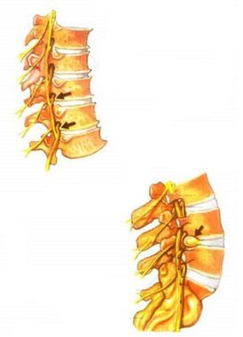 illustration of osteochondrosis of the spine